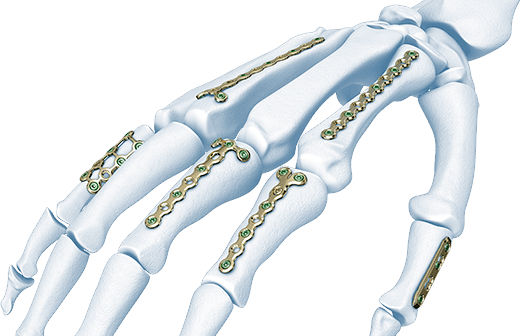 Placca Di Compressione Metacarpo Lcp Depuy Synthes