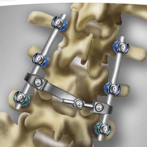 sistema di osteosintesi lombo-sacrale / via posteriore / per adulto