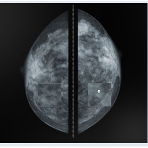 software per mammografia / di ottimizzazione delle immagini / di visualizzazione / diagnostico
