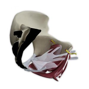 fascetta per ricostruzione per il trattamento del prolasso / via transotturatoria / per donna