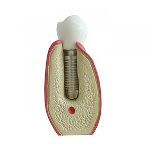 modello anatomico odontoiatrico / di dimostrazione / per implantologia