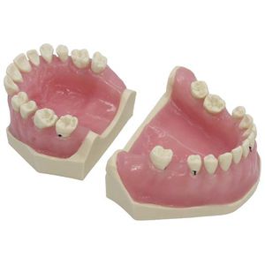 modello anatomico di dentatura / ad uso didattico / di patologia / per parodonzia
