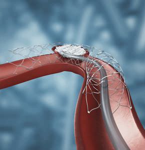 stent intracranico / in nitinol / di supporto per spirale per embolizzazione