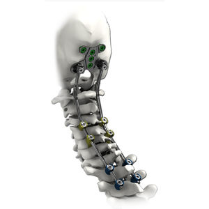 sistema di osteosintesi occipito-cervico-toracico / via posteriore / per adulto