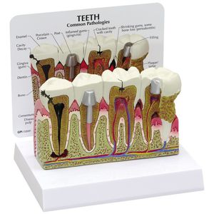 modello anatomico di denti / di patologia