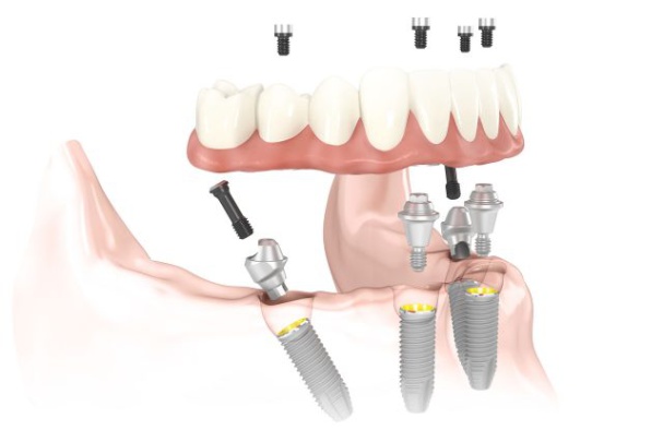 Nobel Biocare Services AG Photo 2