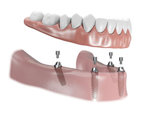Pilastro transmucoso – Dental Tech - Doctor OS