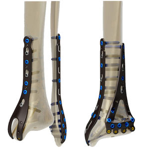 placca di compressione per fibula