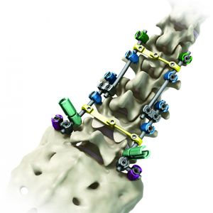 sistema di osteosintesi toraco-lombo-sacrale 1