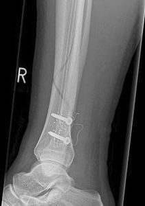 chiodo intramidollare tibia / mediale / distale / prossimale