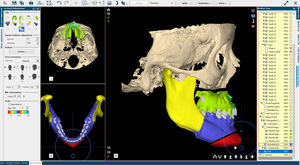 software di pianificazione preoperatoria