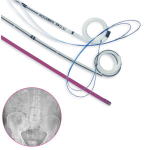 stent ureterale
