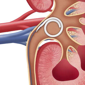 stent ureterale 1