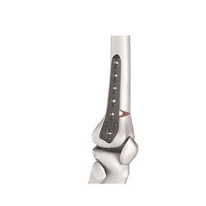 placca per osteotomia femorale