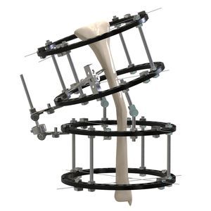 fissatore esterno per tibia 1
