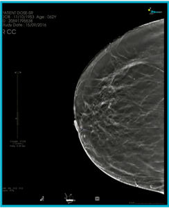 modulo software per mammografia