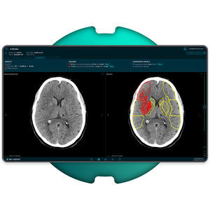 software per diagnosi di ictus