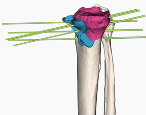 dima di resezione per osteotomia tibiale