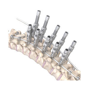 sistema di osteosintesi toraco-lombare