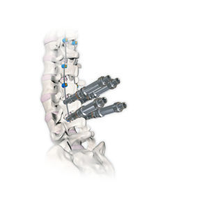 sistema di osteosintesi toraco-lombare 1