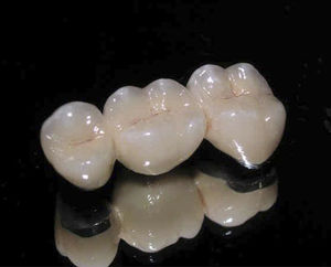 ponte dentale in metallo-ceramica 1