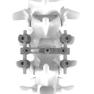 sistema di osteosintesi toraco-lombare 1
