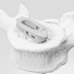gabbia intersomatica toraco-lombare 1