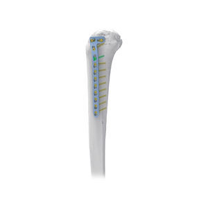 placca di compressione per tibia 1