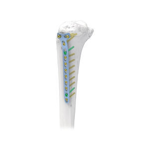 placca di compressione per tibia 1