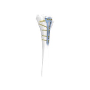 placca di compressione per tibia