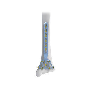 placca di compressione per tibia 1