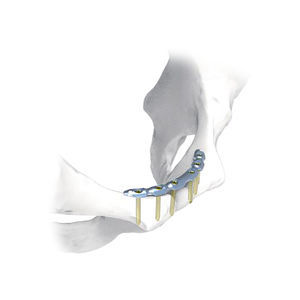 placca di compressione per bacino 1