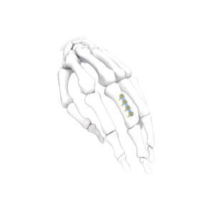 placca di compressione per mano 1