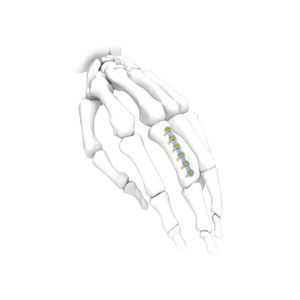 placca di compressione per mano 1