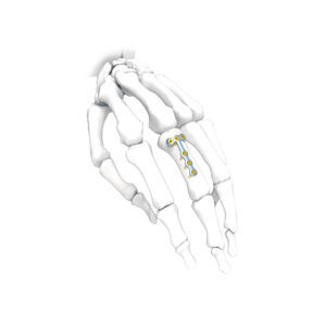 placca di compressione per mano 1