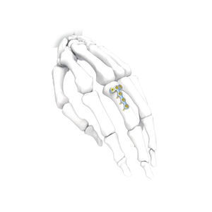placca di compressione per mano 1