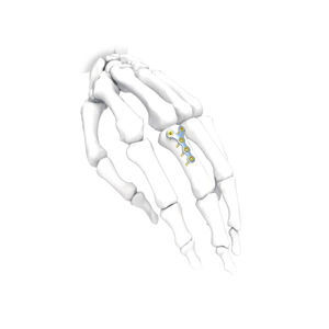 placca di compressione per mano 1