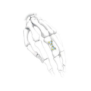 placca di compressione per mano 1