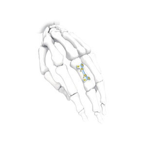 placca di compressione per mano 1