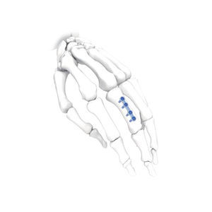 placca di compressione per mano 1