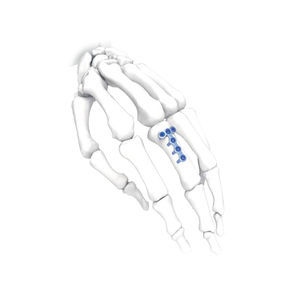 placca di compressione per mano 1