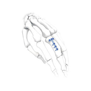 placca di compressione per mano 1