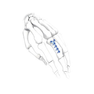 placca di compressione per mano 1