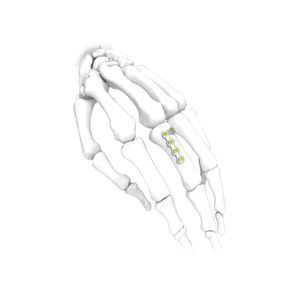placca di compressione per mano 1