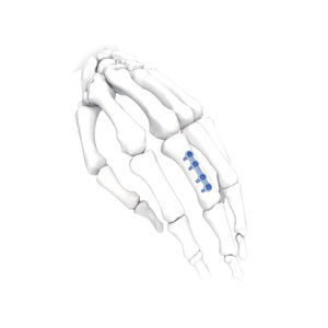 placca di compressione per mano 1
