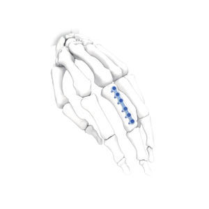 placca di compressione per mano 1