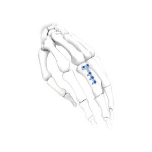 placca di compressione per mano 1