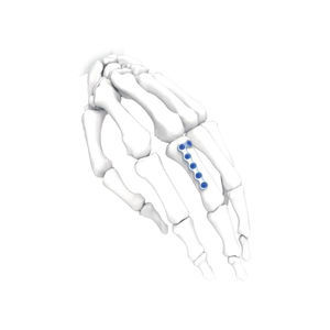 placca di compressione per mano 1