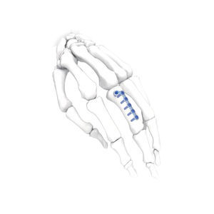 placca di compressione per mano 1