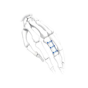 placca di compressione per mano 1